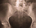 bone x-ray